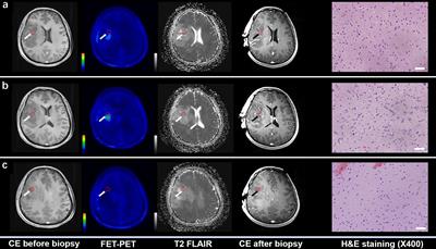 Glioma Imaging by O-(2-18F-Fluoroethyl)-L-Tyrosine PET and Diffusion-Weighted MRI and Correlation With Molecular Phenotypes, Validated by PET/MR-Guided Biopsies